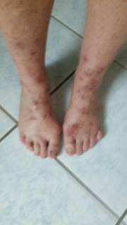 Rash consistent with BP oil product exposure that Trisha Springstead, RN, contracted on Cat Point in 2012. (Photo courtesy of Trisha Springstead.) 